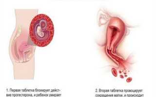 Аборт как причина бесплодия
