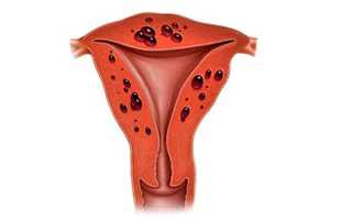 Аденомиоз и бесплодие: причины, симптомы и взаимосвязь
