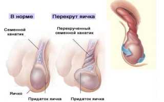 От чего бывает бесплодие у мужчин