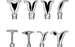 Пороки развития женских половых органов не всегда приводят к бесплодию