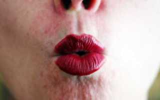 Опухла губа от герпеса как снять опухоль