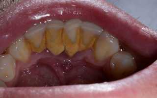 Что такое пародонтальный абсцесс и как его лечить