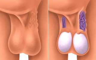 Гипоплазия яичка